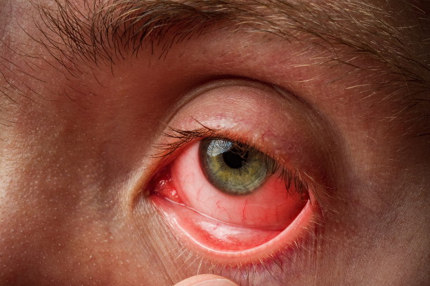tratamiento_conjuntivitis_infecciosa