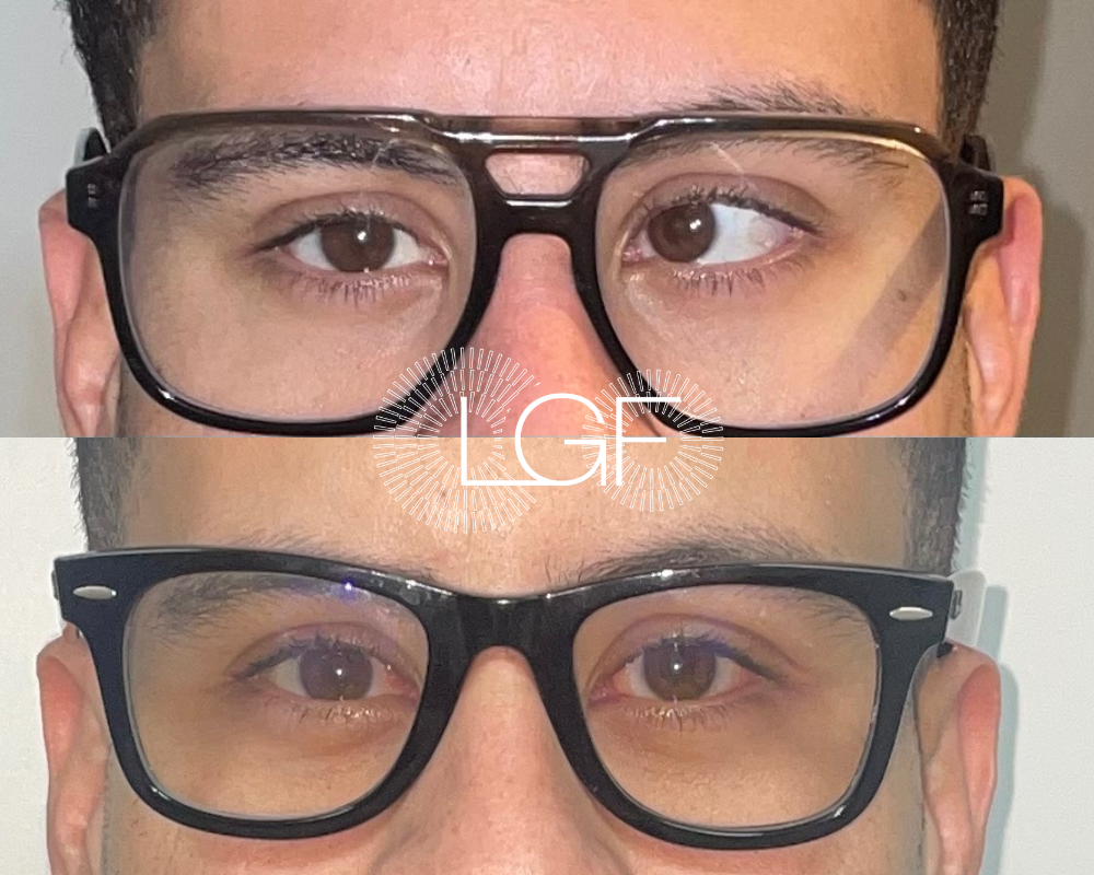 paciente con estrabismo y vision doble antes y despues de cirugia