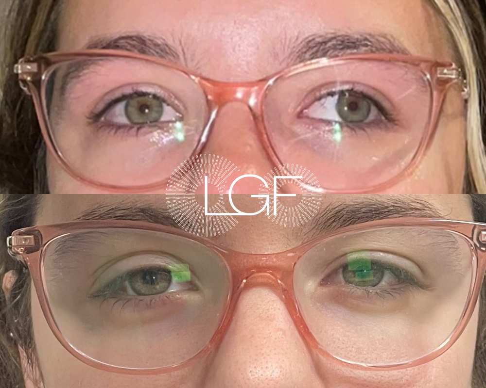 cirugia de exotropia intermitente