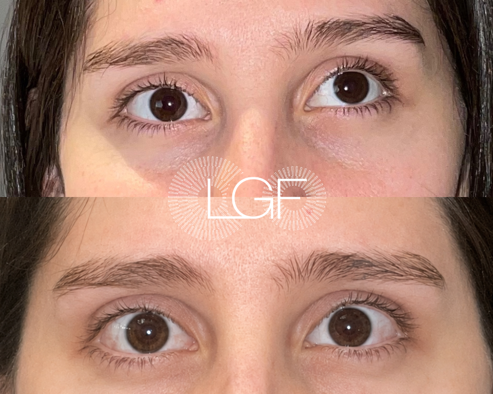 reoperación. exotropia consecutiva